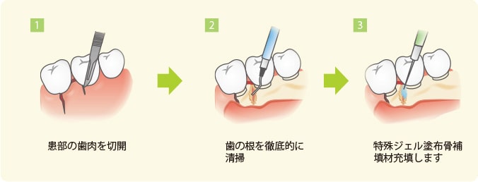 歯槽骨再生治療
