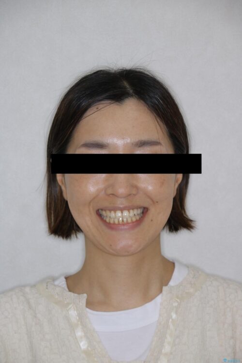 【30代女性】インビザライン、補助装置との組み合わせで顎のゆがみとかみ合わせを治す 治療後画像