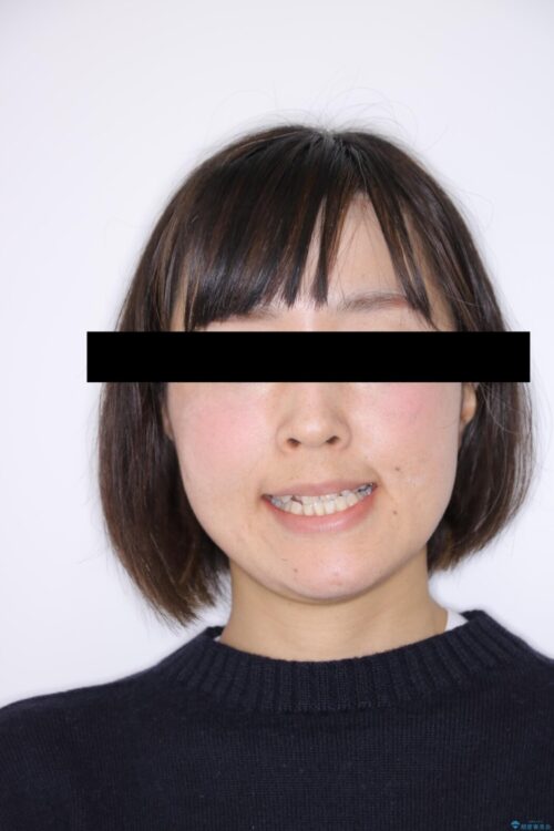 【30代女性】インビザライン、補助装置との組み合わせで顎のゆがみとかみ合わせを治す 治療前画像