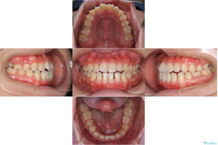 【30代女性】歯茎が薄い方へのインビザライン治療 治療途中画像