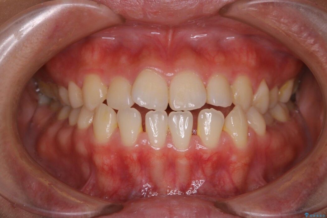 【30代女性】歯茎が薄い方へのインビザライン治療 治療前