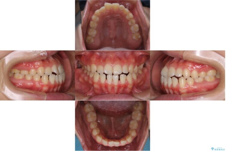 【30代女性】歯茎が薄い方へのインビザライン治療 治療前画像