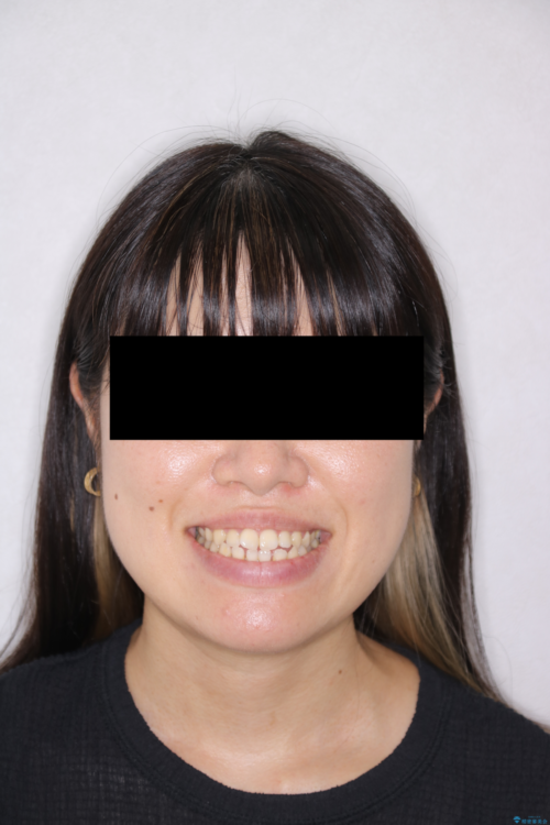 【30代女性】歯茎が薄い方へのインビザライン治療 治療前画像