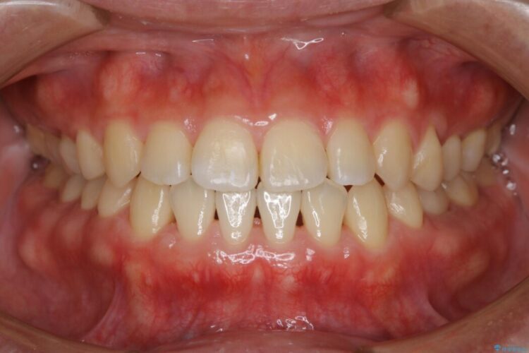 【30代女性】歯茎が薄い方へのインビザライン治療 治療後画像