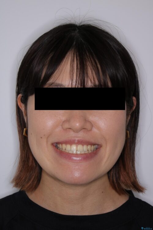 【30代女性】歯茎が薄い方へのインビザライン治療 治療後画像