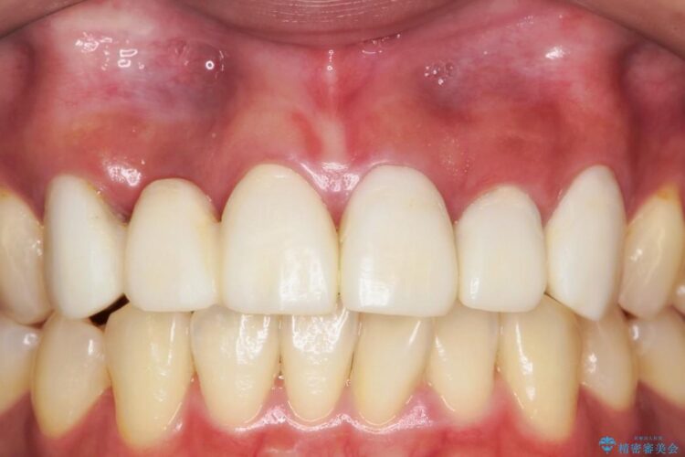 【30代女性】前歯のセラミックブリッジを綺麗に見せる 治療途中画像