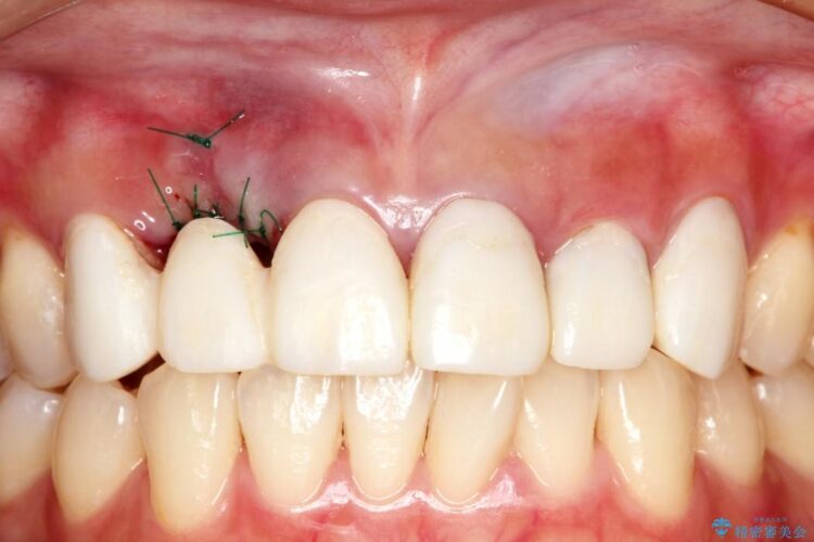 【30代女性】前歯のセラミックブリッジを綺麗に見せる 治療途中画像