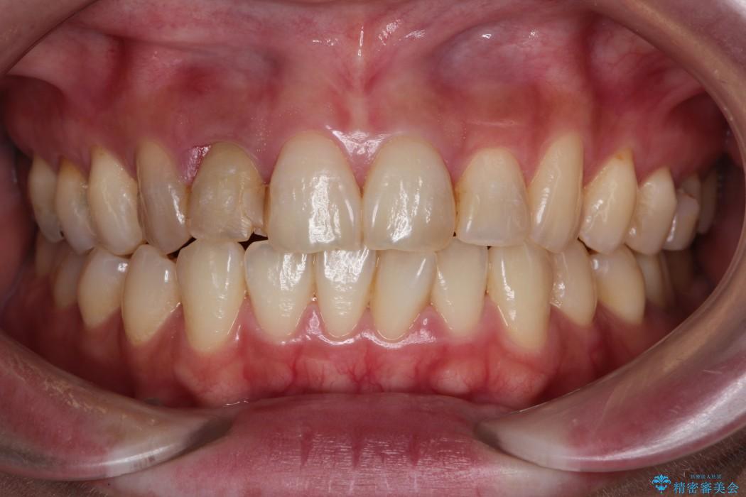 【30代女性】前歯のセラミックブリッジを綺麗に見せる 治療前