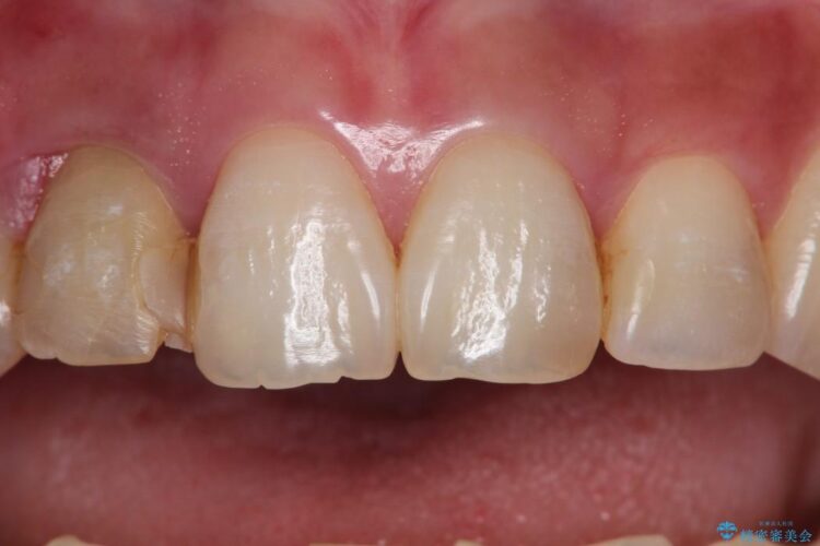 【30代女性】前歯のセラミックブリッジを綺麗に見せる 治療前画像