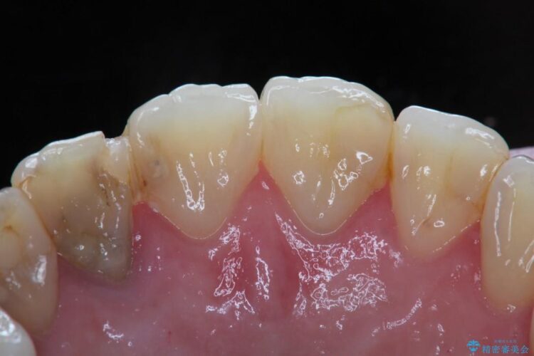 【30代女性】前歯のセラミックブリッジを綺麗に見せる 治療前画像