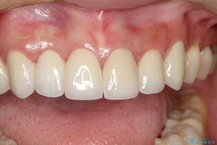 【30代女性】前歯のセラミックブリッジを綺麗に見せる 治療後画像