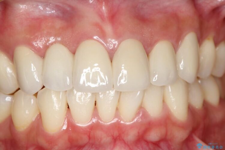 【30代女性】前歯のセラミックブリッジを綺麗に見せる 治療後画像