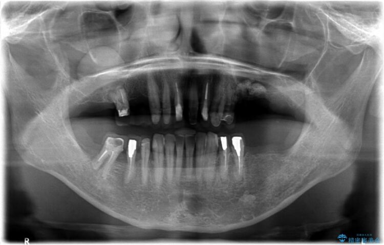 【40代女性】古い金属の治療で奥歯がなくなった方のインプラント、セラミック治療 治療途中画像