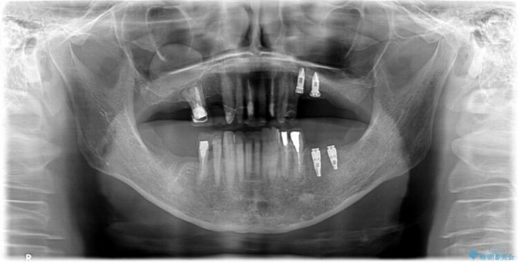 【40代女性】古い金属の治療で奥歯がなくなった方のインプラント、セラミック治療 治療途中画像