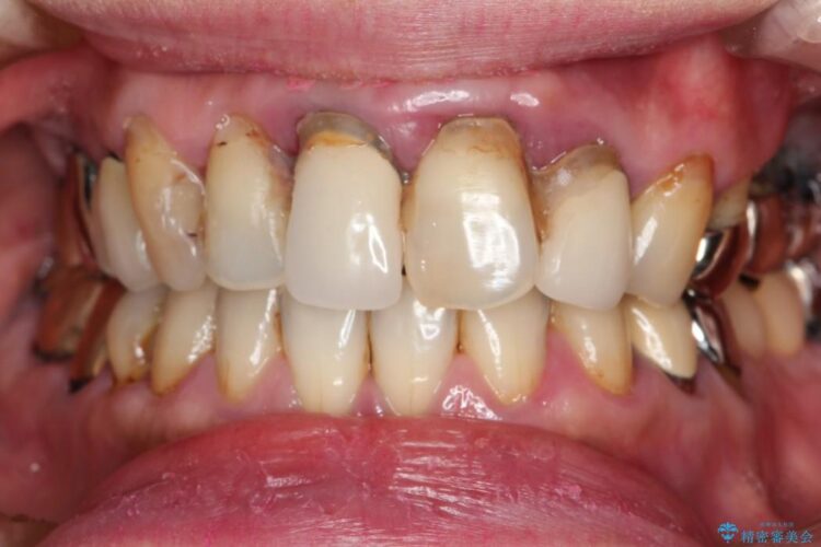 【40代女性】古い金属の治療で奥歯がなくなった方のインプラント、セラミック治療 ビフォー