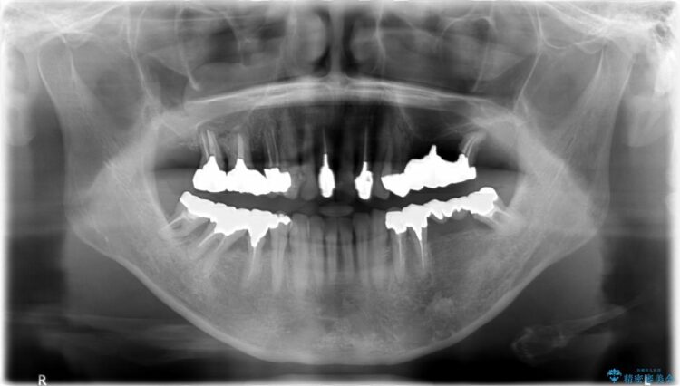 【40代女性】古い金属の治療で奥歯がなくなった方のインプラント、セラミック治療 治療前画像