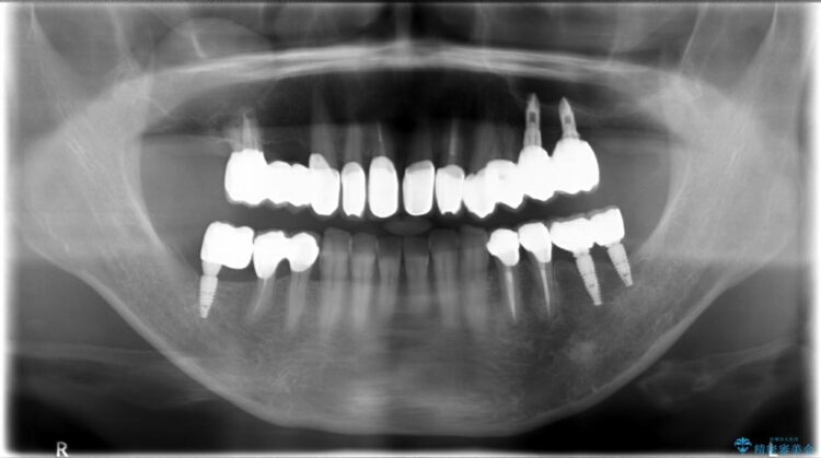 【40代女性】古い金属の治療で奥歯がなくなった方のインプラント、セラミック治療 治療後画像
