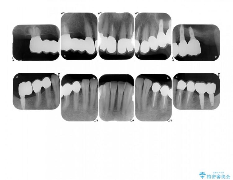 【40代女性】古い金属の治療で奥歯がなくなった方のインプラント、セラミック治療 治療後画像