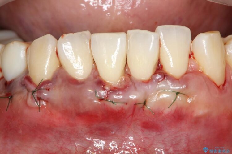 【40代女性】下顎前歯の歯茎再生 治療途中画像