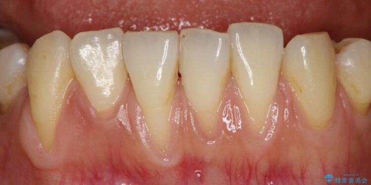 【40代女性】下顎前歯の歯茎再生 治療前画像