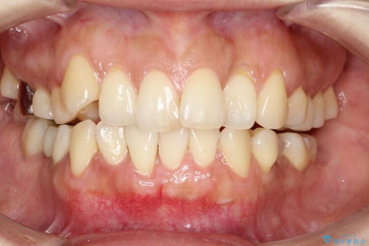 【40代女性】下顎前歯の歯茎再生 治療後画像