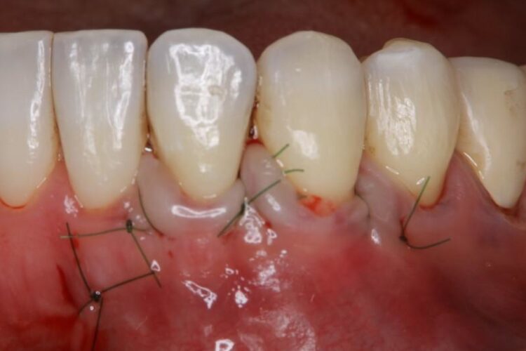 【30代男性】矯正治療で下がってしまった歯茎の移植 治療途中画像