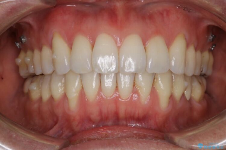 【30代男性】矯正治療で下がってしまった歯茎の移植 治療前画像