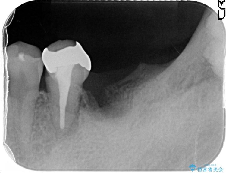 【50代男性】奥歯3本のインプラント治療 治療途中画像
