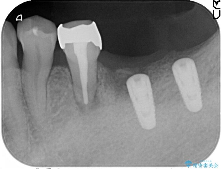 【50代男性】奥歯3本のインプラント治療 治療途中画像