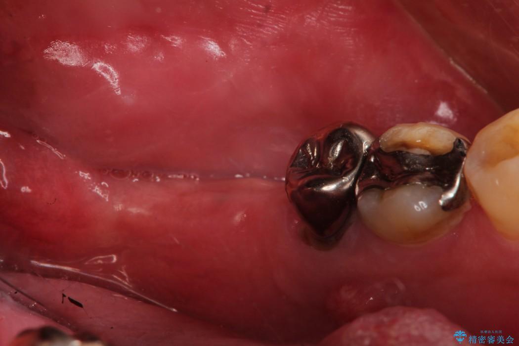 【50代男性】奥歯3本のインプラント治療 治療前