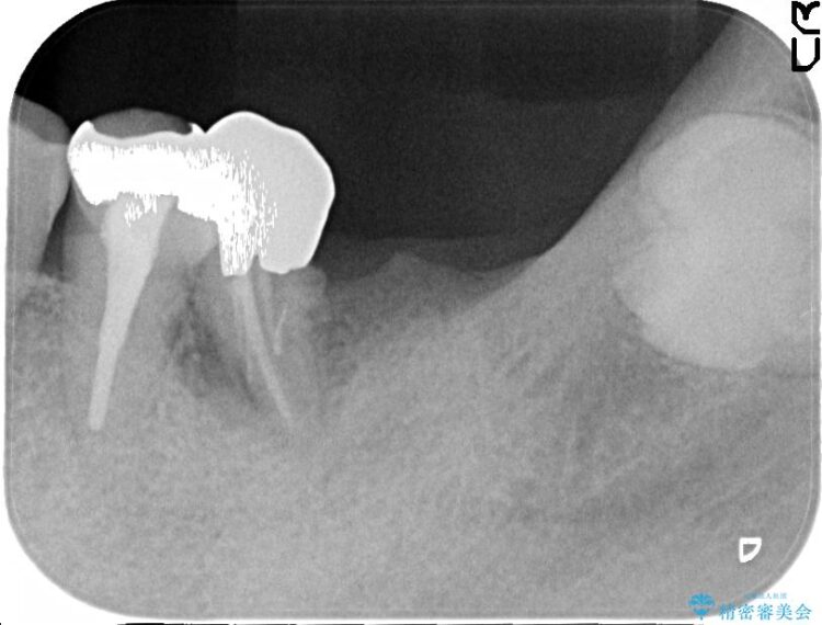 【50代男性】奥歯3本のインプラント治療 治療前画像