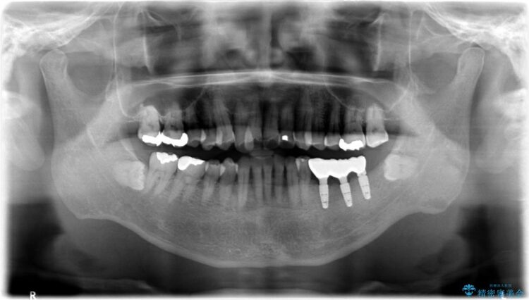 【50代男性】奥歯3本のインプラント治療 治療後画像