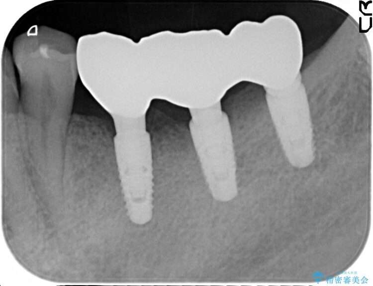 【50代男性】奥歯3本のインプラント治療 治療後画像
