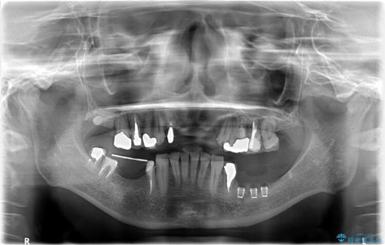 【40代女性】骨の無い下顎のインプラント 治療途中画像