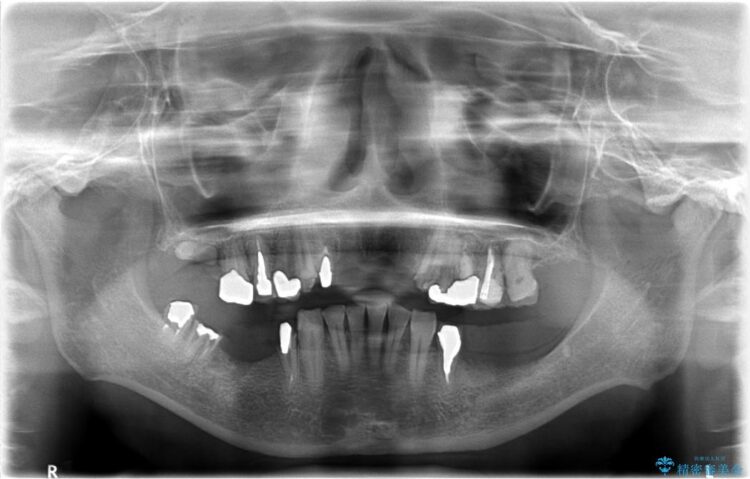 【40代女性】骨の無い下顎のインプラント 治療前画像