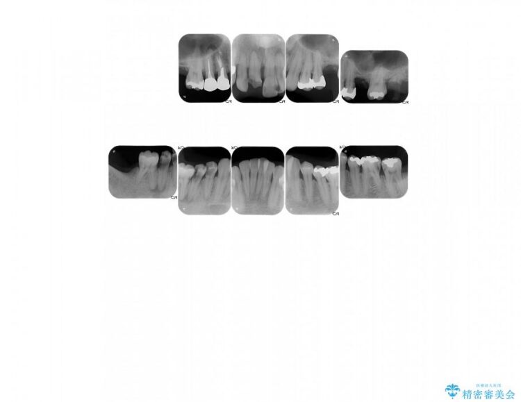 【30代男性】歯周病、矯正、被せものフルコース治療 治療前画像