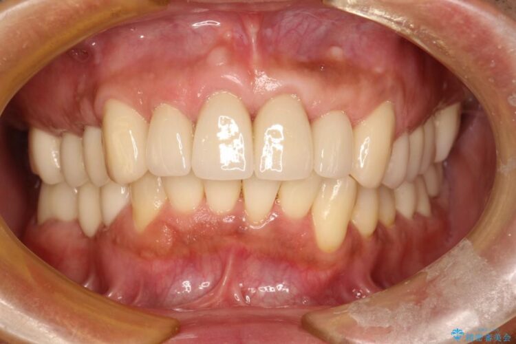 【30代男性】歯周病、矯正、被せものフルコース治療 治療後画像
