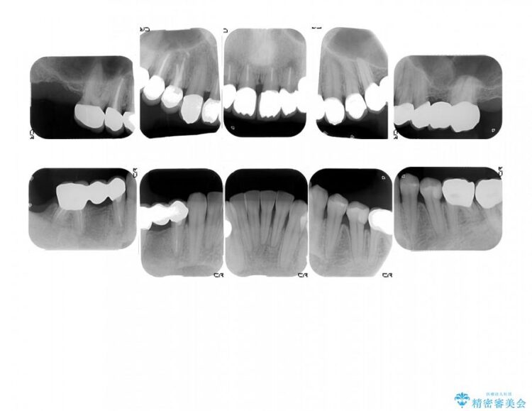 【30代男性】歯周病、矯正、被せものフルコース治療 治療後画像