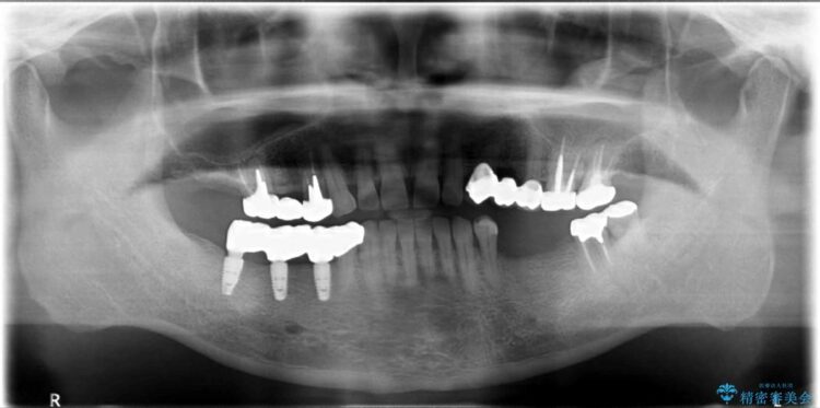 【50代男性】右下奥歯のインプラント 治療後画像