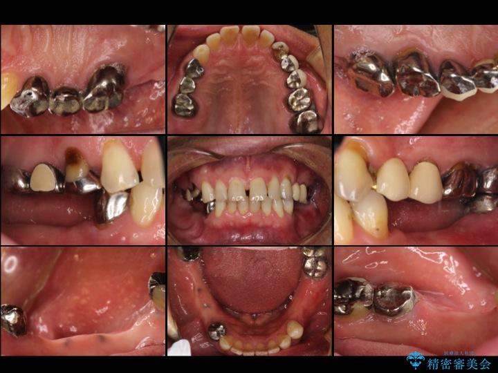 【50代男性】右下奥歯のインプラント ビフォー