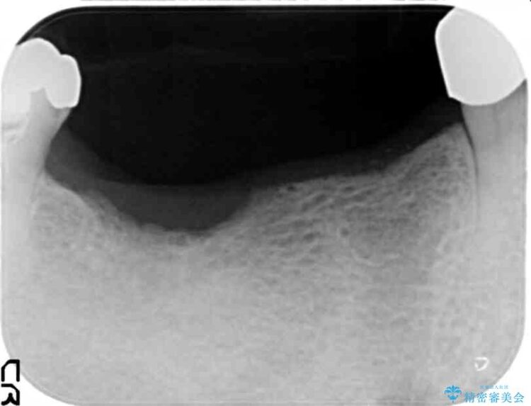 【50代男性】右下奥歯のインプラント 治療前画像
