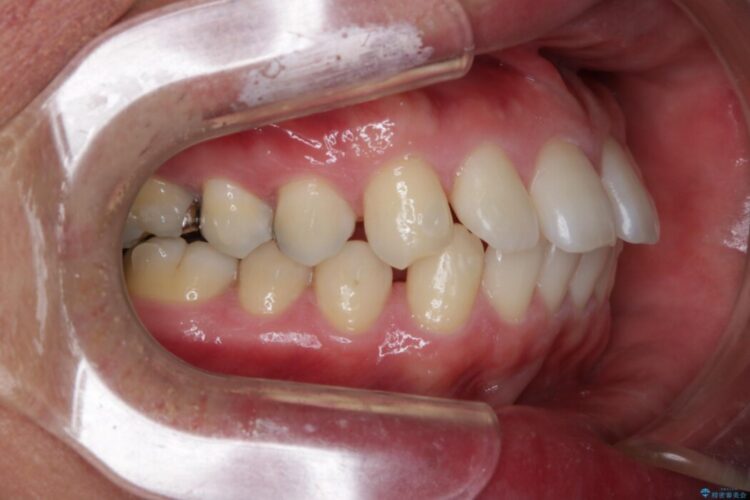 【30代男性】インビザライン・ライトで”すきっ歯と出っ歯”を改善 治療途中画像