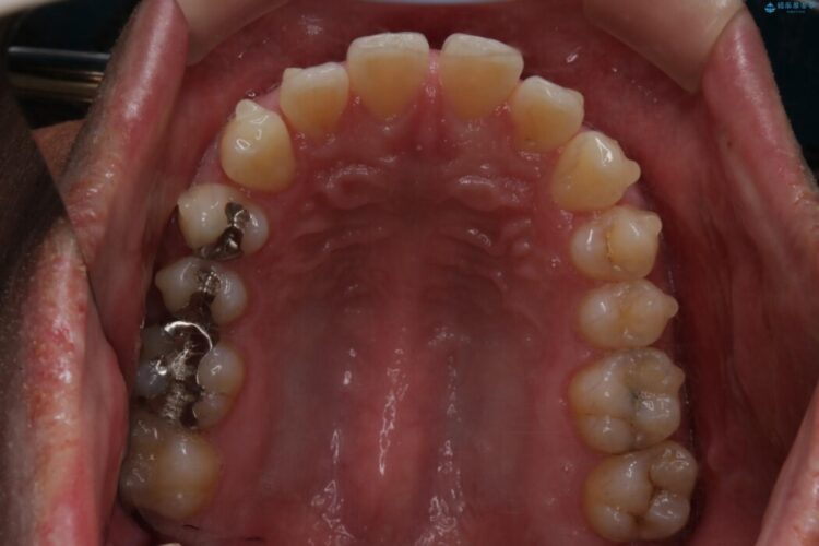 【30代男性】インビザライン・ライトで”すきっ歯と出っ歯”を改善 治療途中画像