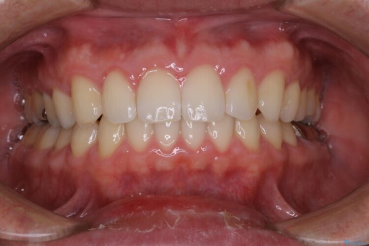 【30代男性】インビザライン・ライトで”すきっ歯と出っ歯”を改善 治療後画像