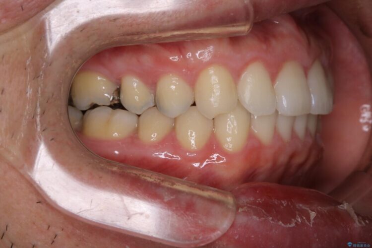 【30代男性】インビザライン・ライトで”すきっ歯と出っ歯”を改善 治療後画像