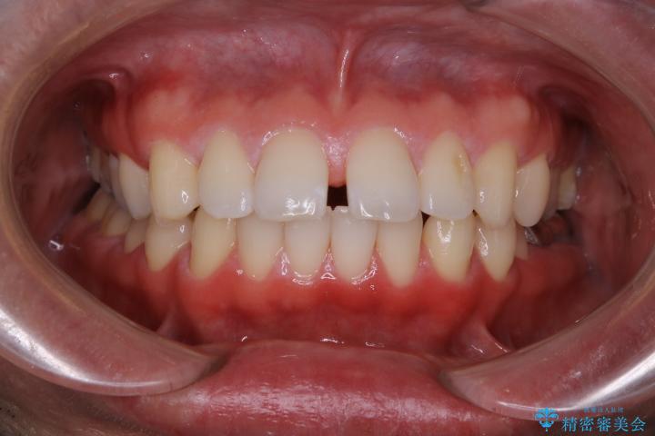 【30代男性】インビザライン・ライトで”すきっ歯と出っ歯”を改善 治療前