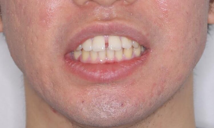 【30代男性】インビザライン・ライトで”すきっ歯と出っ歯”を改善 治療前画像