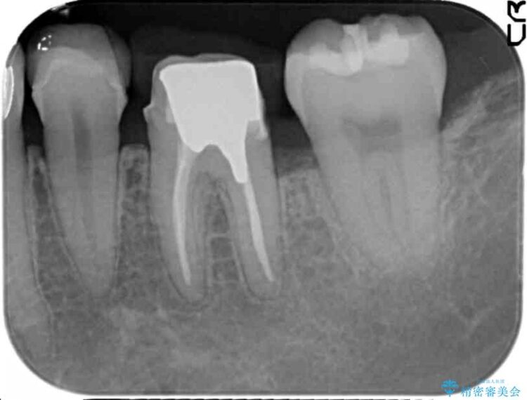 【30代女性】深い虫歯と銀歯をきれいなセラミックに 治療途中画像