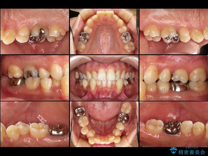 【30代女性】深い虫歯と銀歯をきれいなセラミックに 治療前