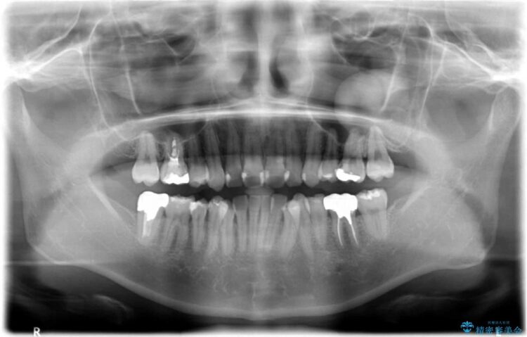 【30代女性】深い虫歯と銀歯をきれいなセラミックに 治療前画像